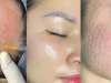 Đẩy TBG 10GF Tăng Sinh COLLAGEN Phục Hồi